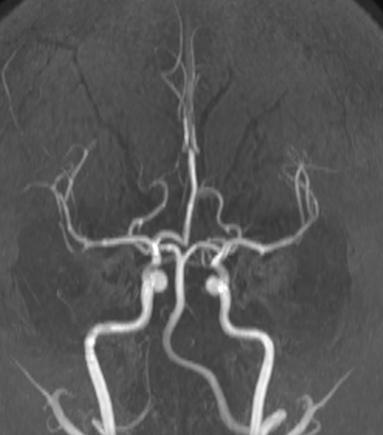 Azygos Anterior Cerebral Artery 