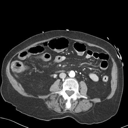 Mesenteric Artery Occlusion