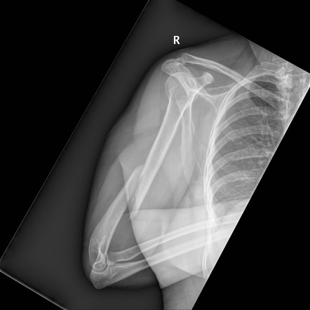 Humeral fracture - spiral midshaft | Image | Radiopaedia.org