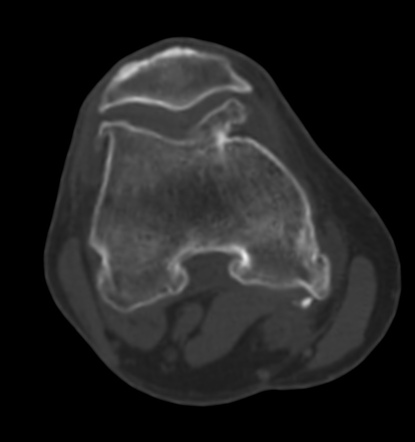 Osteoarthritis of the knee | Image | Radiopaedia.org