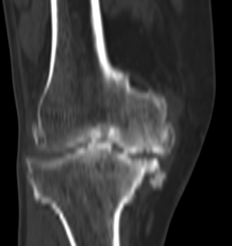 Osteoarthritis of the knee | Image | Radiopaedia.org