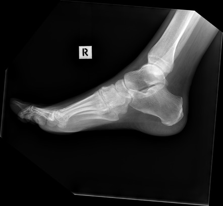 Bilateral Charcot joints with Lisfranc injuries | Image | Radiopaedia.org