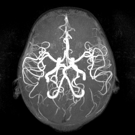 Normal pediatric MRI and MRA brain | Image | Radiopaedia.org