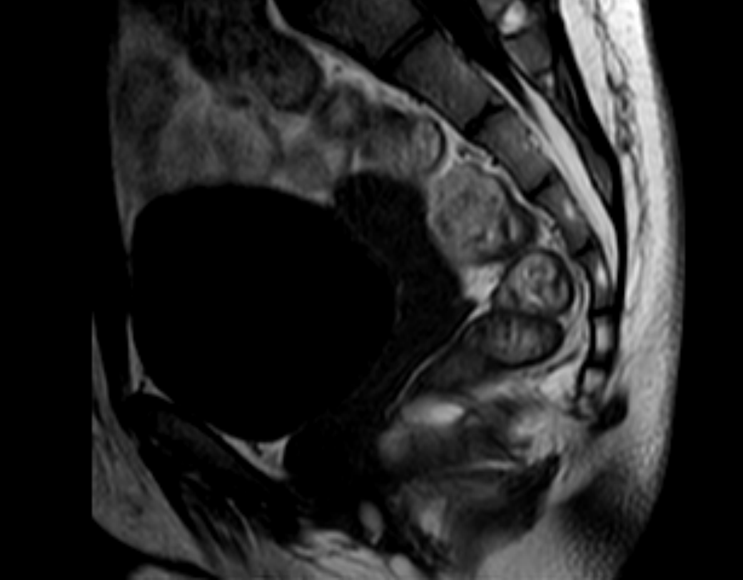 Coccygeal dermal sinus | Image | Radiopaedia.org