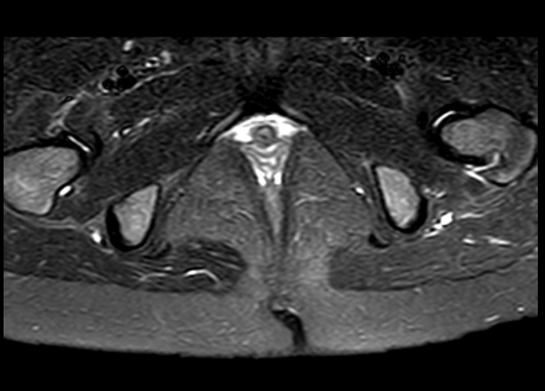 Coccygeal dermal sinus | Image | Radiopaedia.org