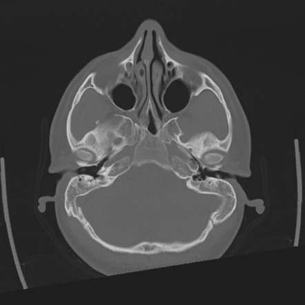 Mastoid Air Cells Anatomy