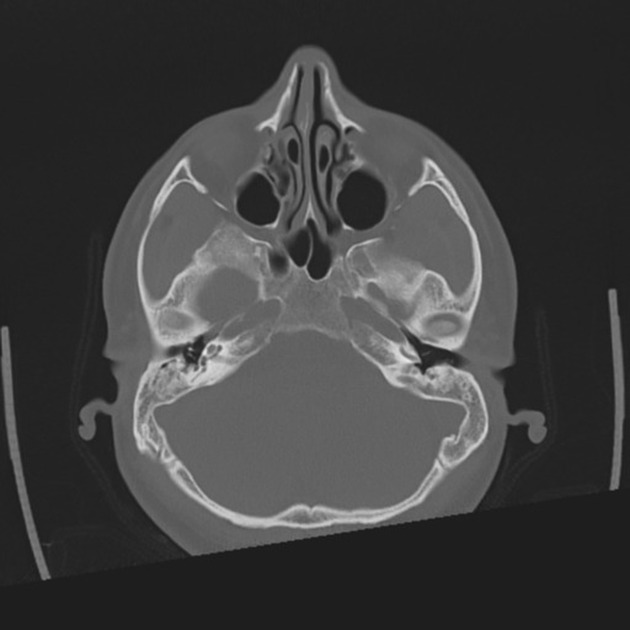 Hyperpneumatisation Of Mastoid Air Cells Radiology Case Radiopaedia Org