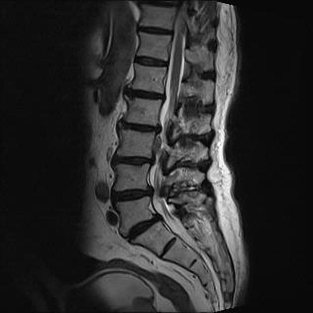 Sequestrated lumbar disc fragment, Radiology Case