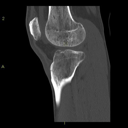 Tibia plateau fracture with lipohemarthrosis (and FBI sign) | Image ...