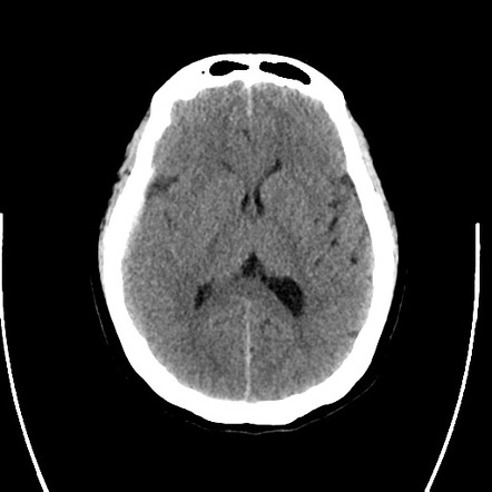 Spontaneous subdural haematomas | Radiology Case | Radiopaedia.org