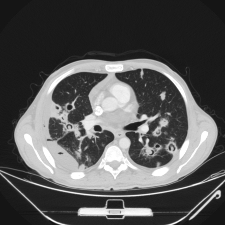 Pulmonary Aspergillosis: Multiple Aspergillomas | Radiology Case ...