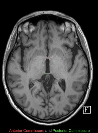 Neuroanatomical landmarks | Radiology Case | Radiopaedia.org