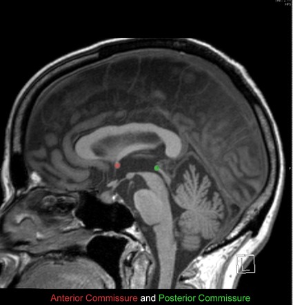 Neuroanatomical Landmarks | Image | Radiopaedia.org