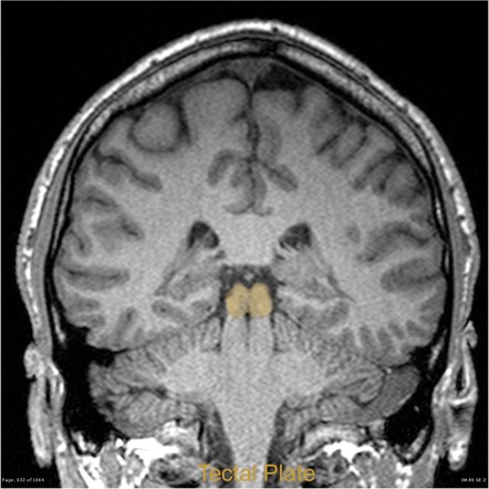 Neuroanatomical Landmarks | Image | Radiopaedia.org