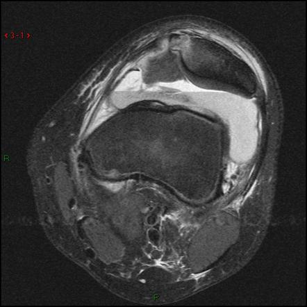 Transient patellar dislocation with trochlear dysplasia | Radiology ...