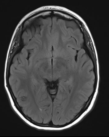 Cerebral cavernous venous malformation | Image | Radiopaedia.org