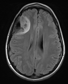 Diffuse astrocytoma NOS (