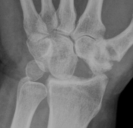 Proximal row carpectomy | Radiology Reference Article | Radiopaedia.org