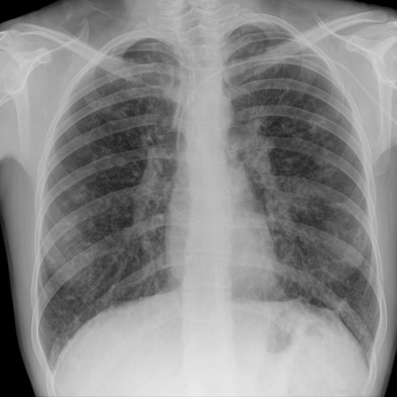 PICC line | Radiology Case | Radiopaedia.org