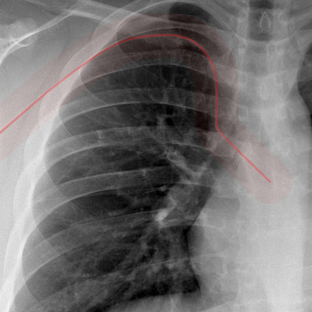 Chest x-ray: PICC position (summary) | Radiology Reference Article ...