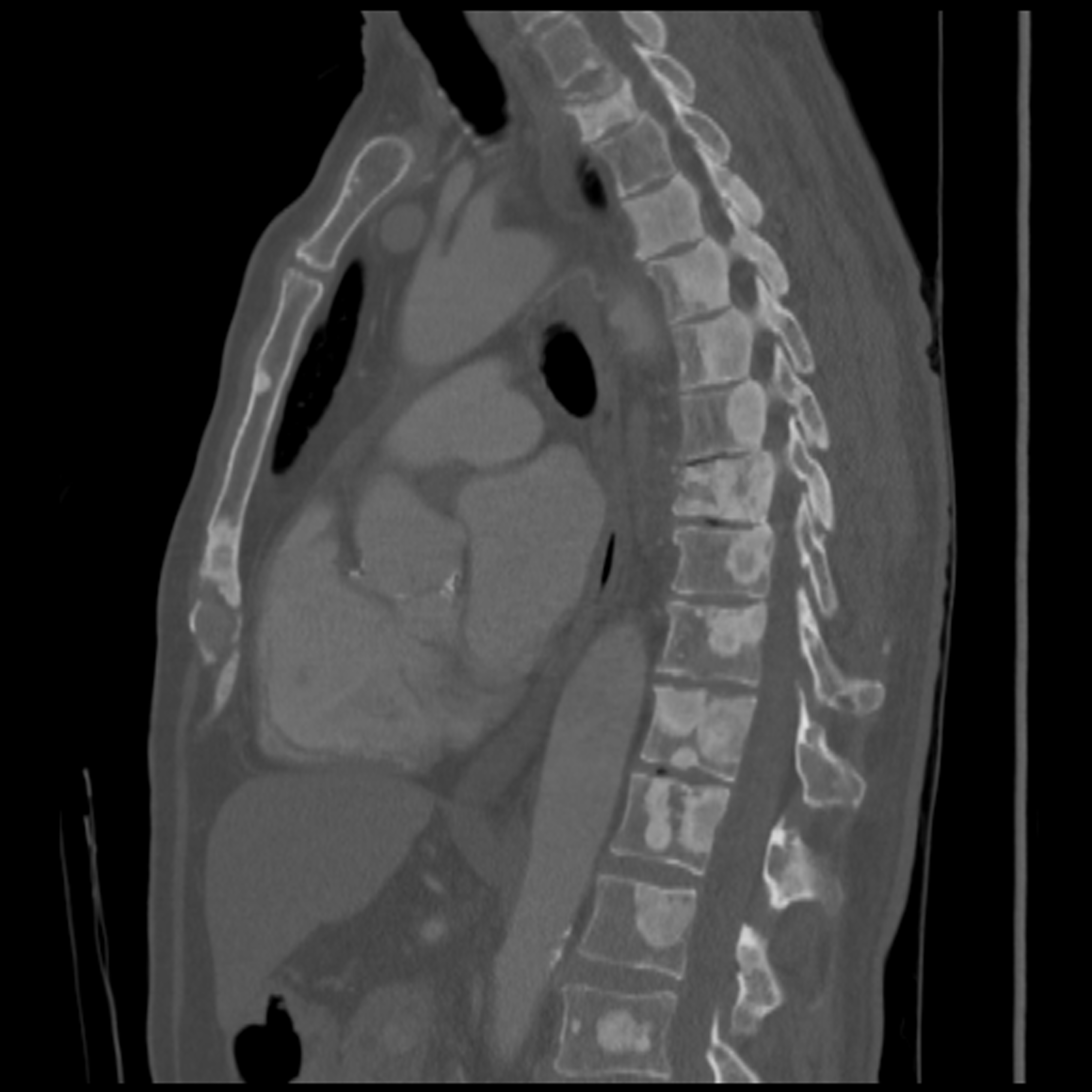 metastatic-prostate-cancer-bonetumor