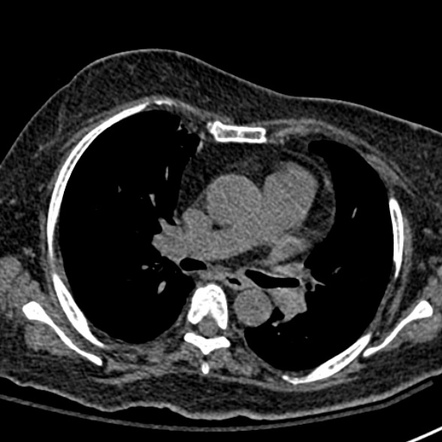 Bronchus suis | Image | Radiopaedia.org