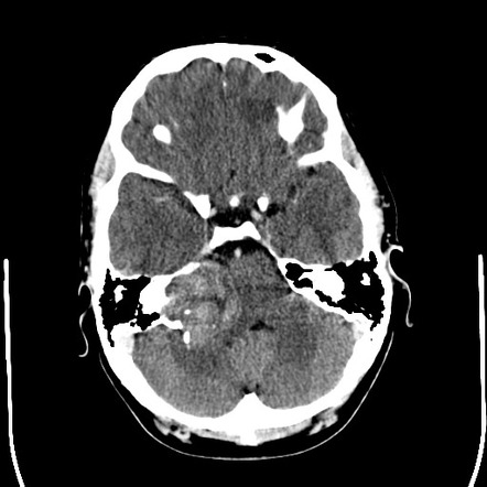 Petrous apex lesions (differential) | Radiology Reference Article ...