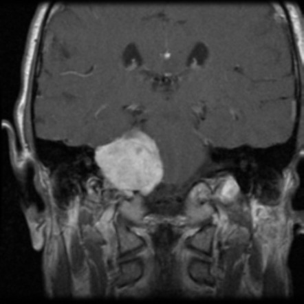 Acoustic Schwannoma - Eroding Petrous Apex 