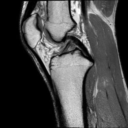 Osteochondritis dissecans | Image | Radiopaedia.org