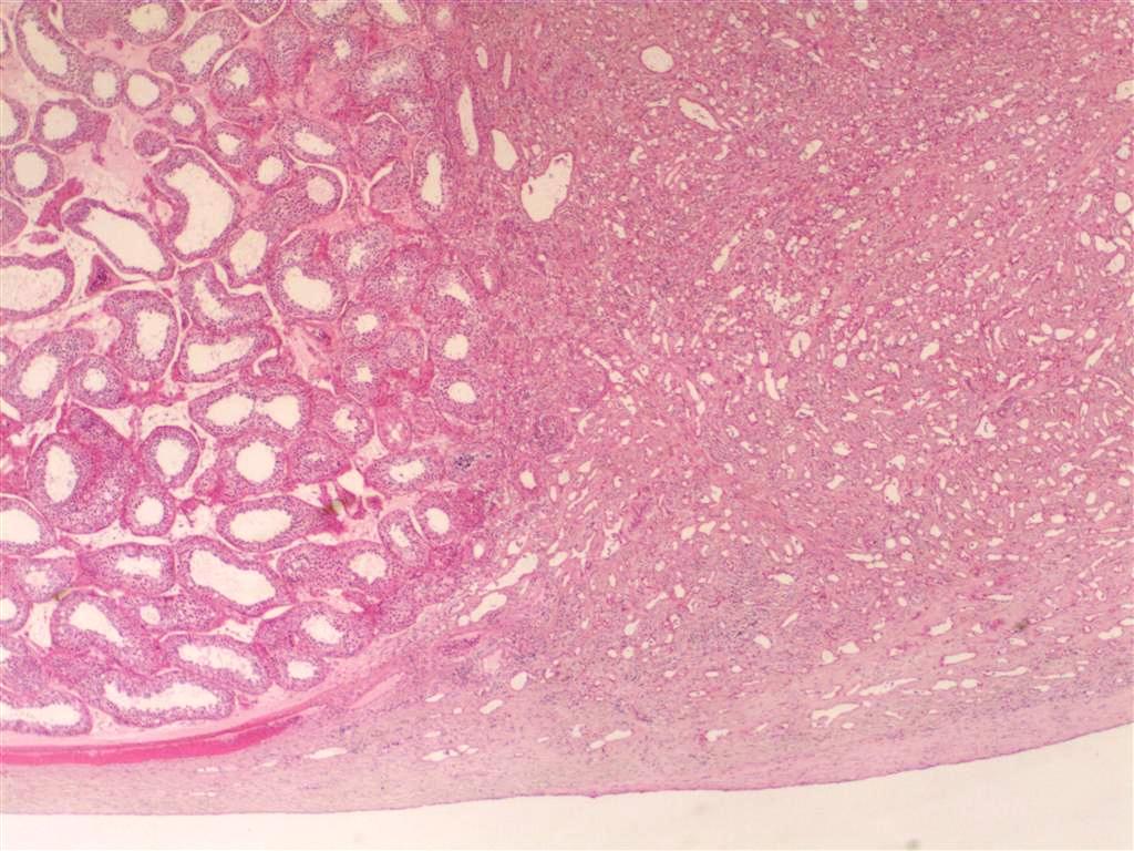 Adenomatoid Tumor Of The Scrotum Pathology Image