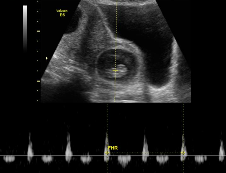 Cesarean Scar Ectopic Pregnancy Image