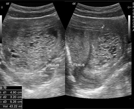 Complete hydatidiform mole | Radiology Case | Radiopaedia.org