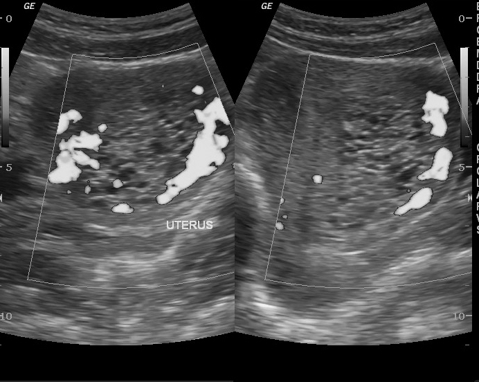 Complete Hydatidiform Mole Image