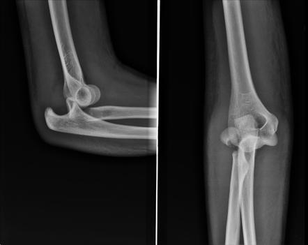 Elbow dislocation | Radiology Reference Article | Radiopaedia.org