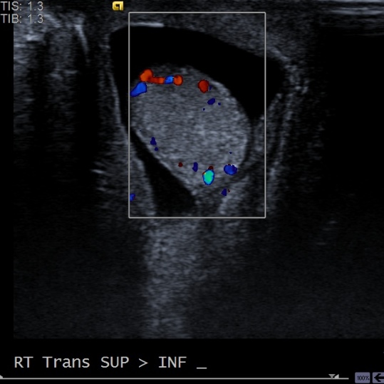 File:Testicular torsion - neonatal, delayed (Radiopaedia 16191-15869 ...