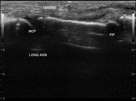 Foreign body induced synovitis of finger | Image | Radiopaedia.org