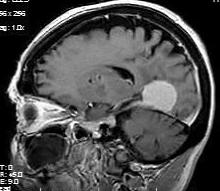 Multiple Meningiomas Image Radiopaedia Org