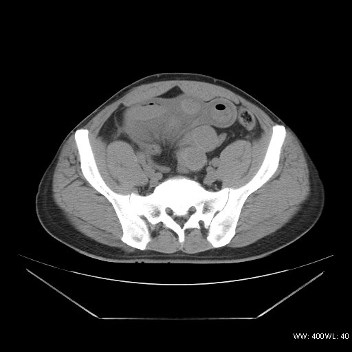 Ischemic bowel disease (gangrenous) | Image | Radiopaedia.org