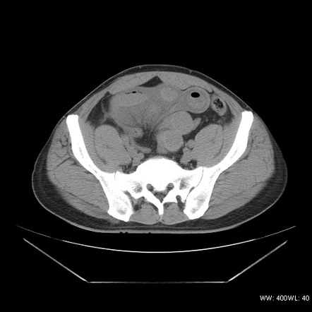 Ischemic Bowel Disease (gangrenous) 