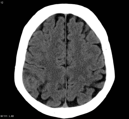 Glioblastoma NOS | Radiology Case | Radiopaedia.org