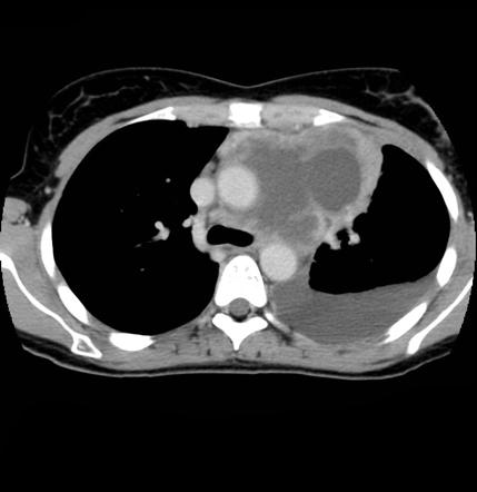 Lymphoma - Mediastinal | Radiology Case | Radiopaedia.org