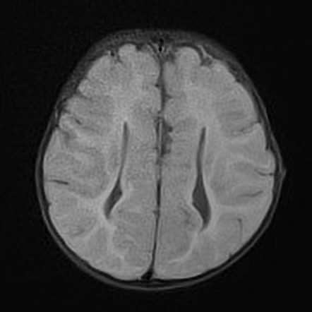 Agenesis of the corpus callosum | Radiology Case | Radiopaedia.org