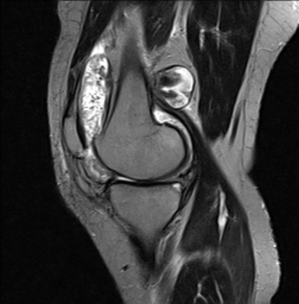 new research for pigmented villonodular synovitis