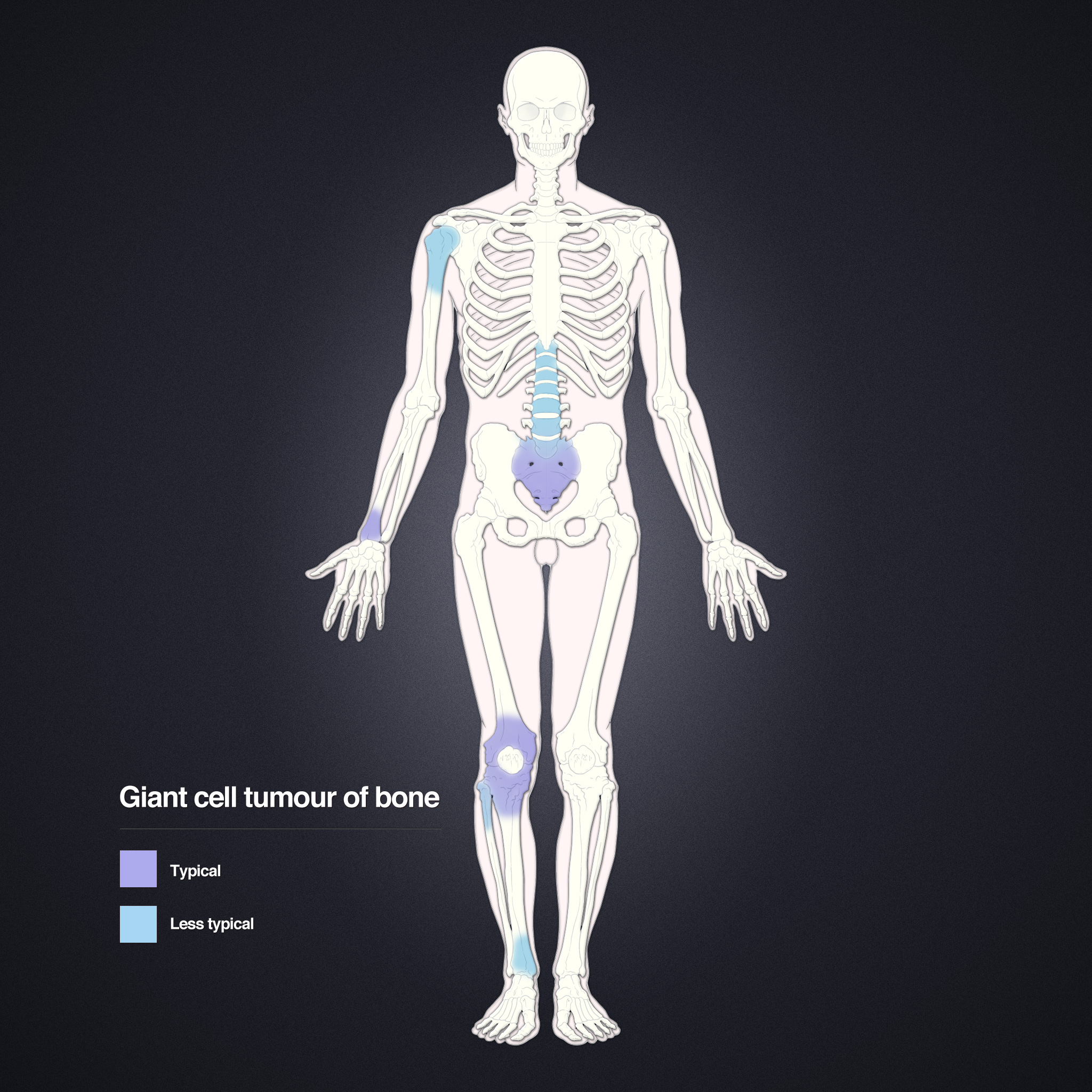 Giant Cell Tumor | Image | Radiopaedia.org