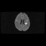 CNS Aspergillosis | Radiology Reference Article | Radiopaedia.org