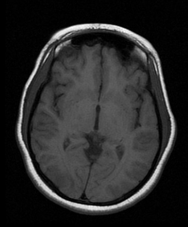 Posterior reversible encephalopathy syndrome | Image | Radiopaedia.org