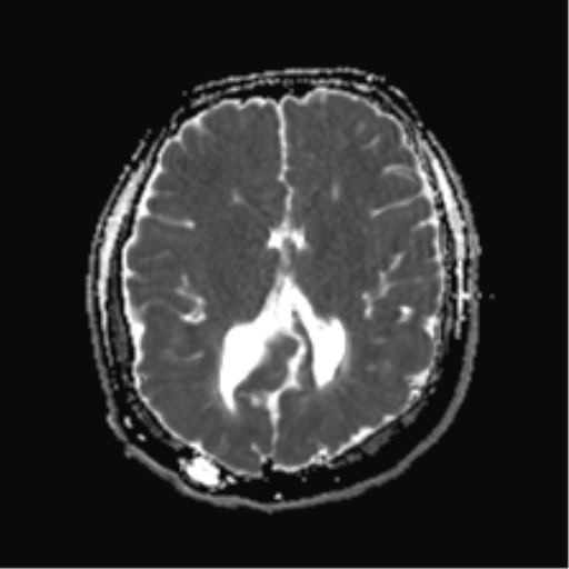 Chiari II malformation | Image | Radiopaedia.org