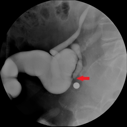 Ileal conduit | Radiology Reference Article | Radiopaedia.org