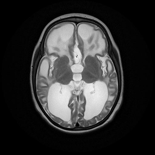 Megalencephalic leucoencephalopathy with subcortical cysts (Van Der ...