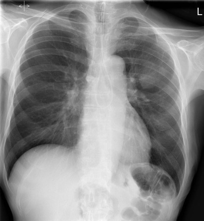 Viewing playlist: FY Nasogastric Tube Placement | Radiopaedia.org